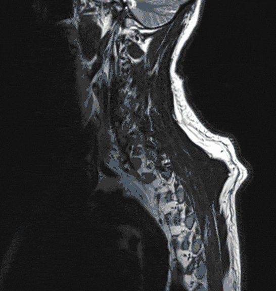 Meningeom-spinal_Wirbelsaeule Meningeom-spinal_Wirbelsaeule