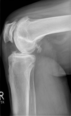 Ro_Bilder_praeop_1_2 Röntgenbild vor OP von seitlich